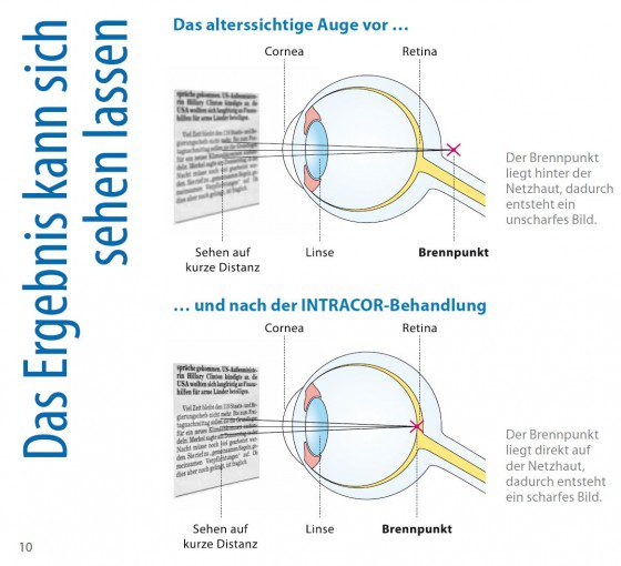 Intracor Augenlaser-Operation - Infoflyer (www.intracor.net/dasat/images/4/100664-broschuere-intracor.pdf)