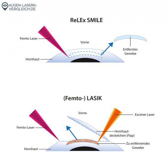 Den Unterschied zwischen Augenlasern mit ReLEx Smile vs. (Femto-)LASIK zeigt auch diese Infografik von augen-lasern-vergleich.de sehr schön