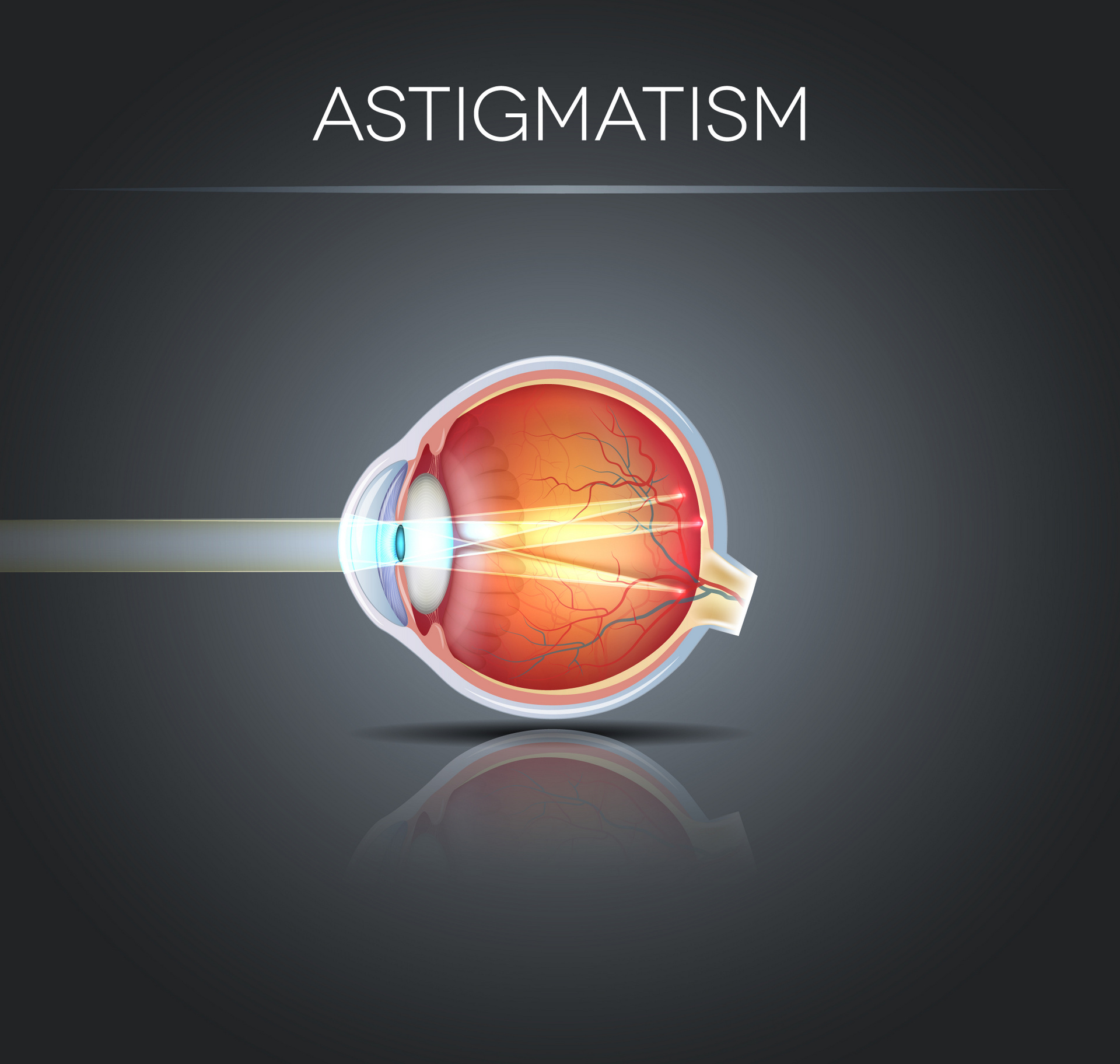 Astigmatismus: Was kostet Augenlasern bei Hornhautverkrümmung? (© reineg / Fotolia)